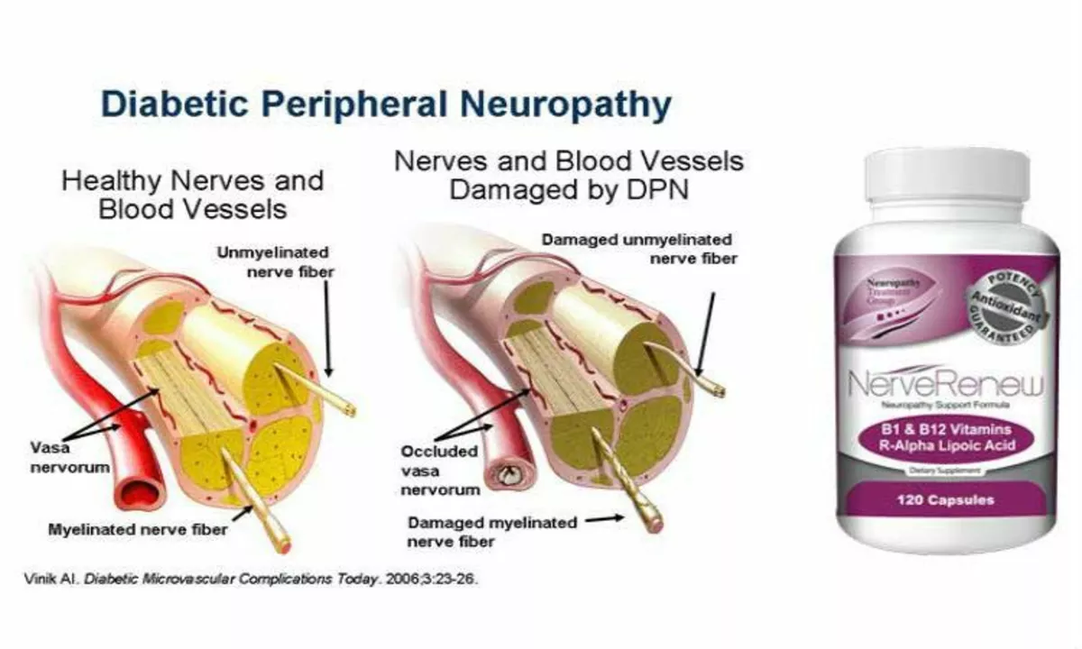 Diabetic Peripheral Neuropathy and Vision Loss: What You Need to Know