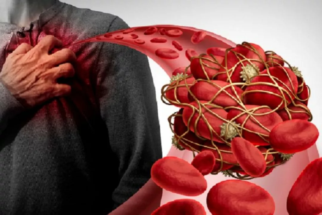 The relationship between blood clots in stents and heart attacks